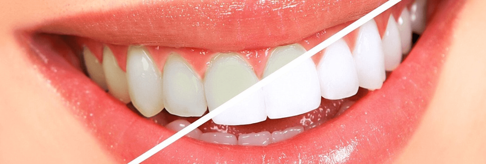 ascroft medical - white teeth